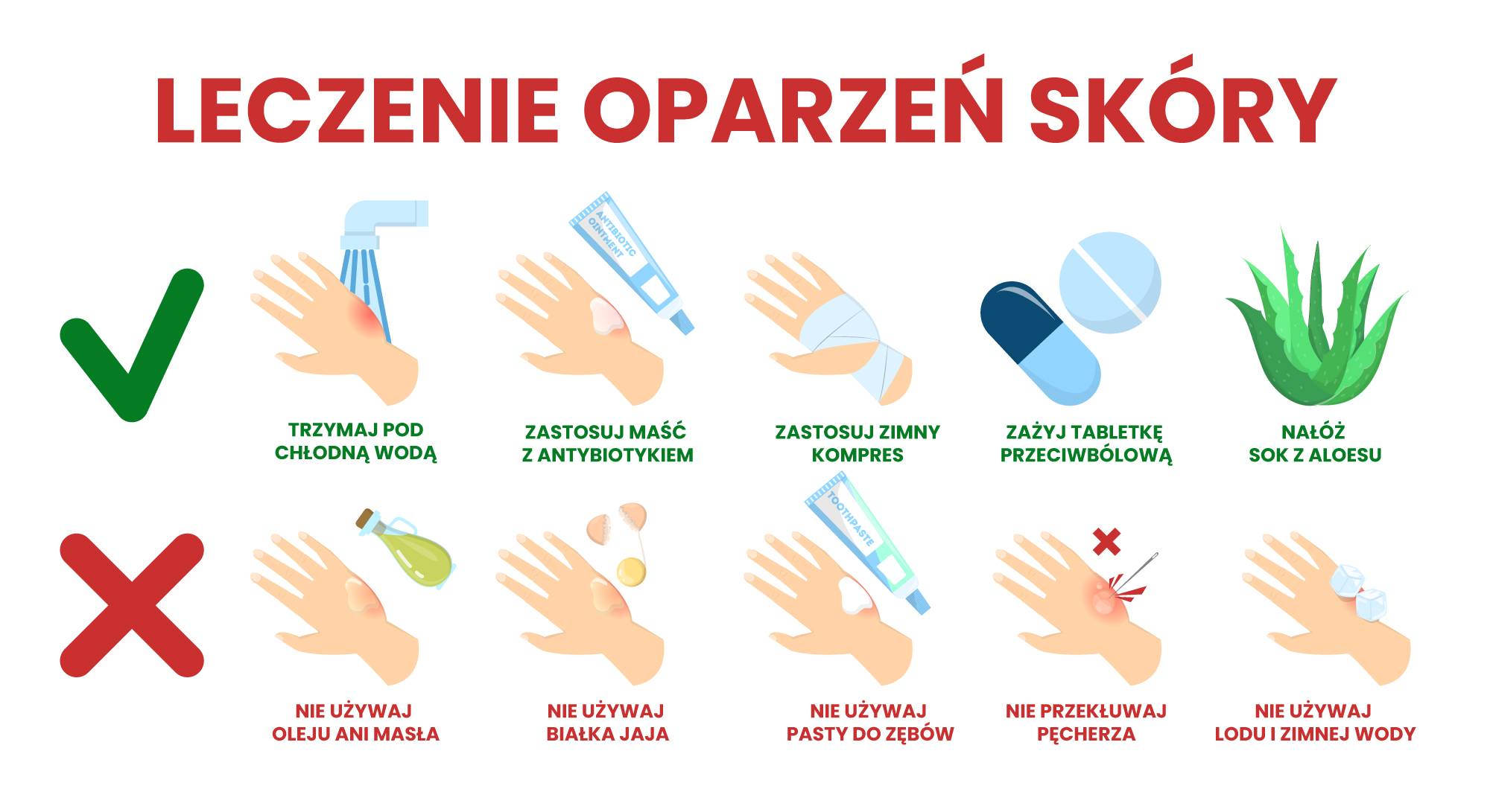 Oparzenia skóry - jak udzielić pierwszej pomocy? Infografika obrazująca leczenie oparzeń.